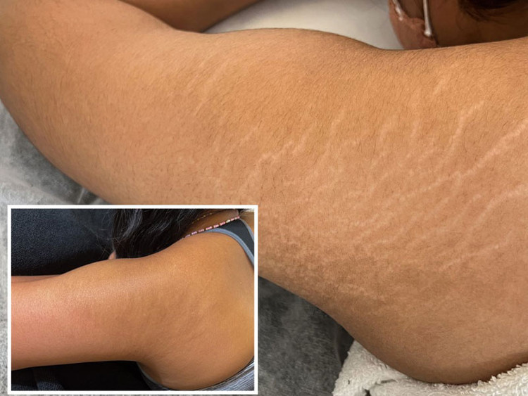 کرم رفع ترک های پوستی بارداری یا استرچ مارک برند گاتیو ایتالیا 100 میل
